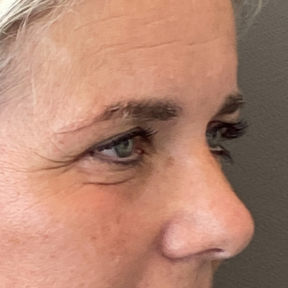 foer-efter-oejenlaagsoperation3-website