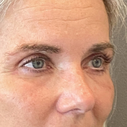 foer-efter-oejenlaagsoperation4-website