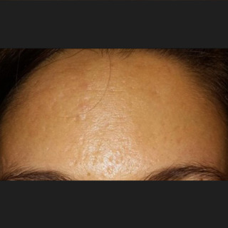 Skinpen-akne-efter1