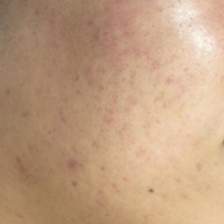 Skinpen-akne-efter3-300x300 1 (1)