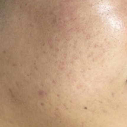 Cerix: Nærbillede af ansigtshud med rødlige akneudbrud, små betændte knopper, ar, pigmentpletter og ujævn tekstur. Billedet bruges til dokumentation af aknebehandling hos Cerix, med fokus på ansigtets overflade, porer, rødme og klinisk før‑efter vurdering. Eksempelvis kemisk peeling eller laserbehandling til hudforbedring.