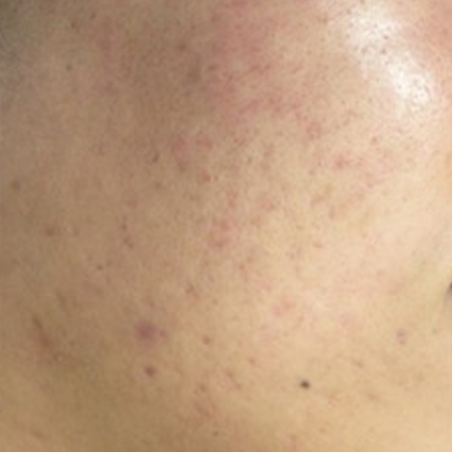 Cerix: Nærbillede af ansigtshud med rødlige akneudbrud, små betændte knopper, ar, pigmentpletter og ujævn tekstur. Billedet bruges til dokumentation af aknebehandling hos Cerix, med fokus på ansigtets overflade, porer, rødme og klinisk før‑efter vurdering. Eksempelvis kemisk peeling eller laserbehandling til hudforbedring.