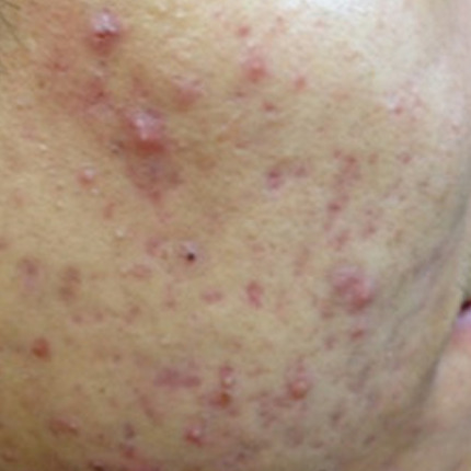 Cerix: Nærbillede af en patients ansigt/kind med udbredt rødme, betændte bumser, pustuler og små ar efter akne. Billedet illustrerer behovet for hud-/acnebehandling hos Cerix og viser tekstur, porer og ujævnheder på ansigtets hudoverflade. Før-billede til professionel medicinsk aknebehandling eller laserterapi.