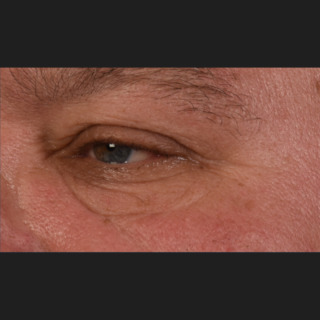 Skinpen-rynker-efter3-new