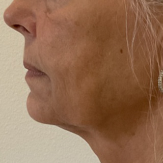 skinbooster-3-behandlinger-cerix-efter1