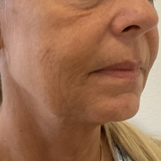 skinbooster-3-behandlinger-cerix-efter2