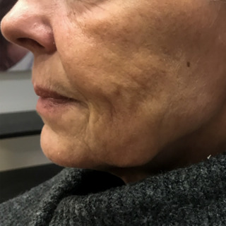skinbooster-3-behandlinger-cerix-før1