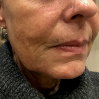 skinbooster-3-behandlinger-cerix-før2