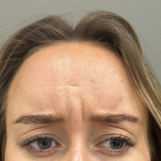 bekymring-botox-web1