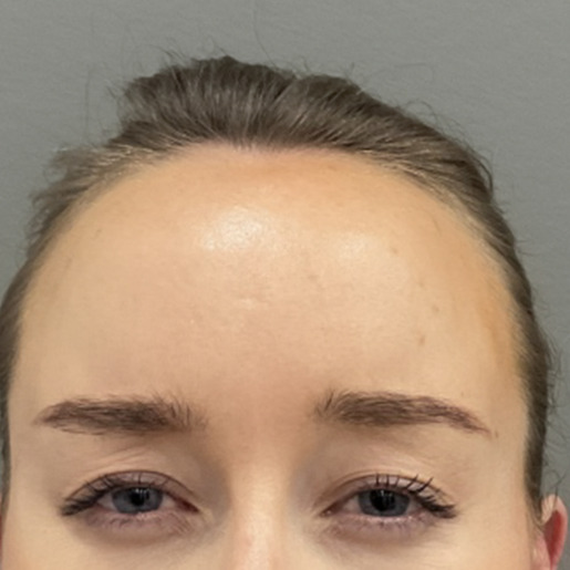 bekymring-botox-web2