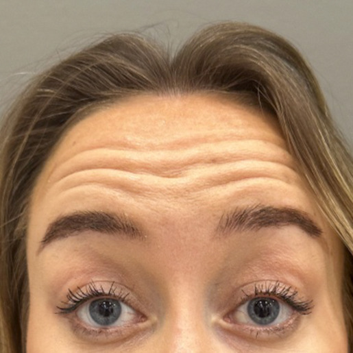 panderynker-botox-web1