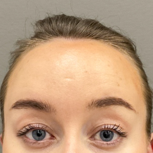 panderynker-botox-web2
