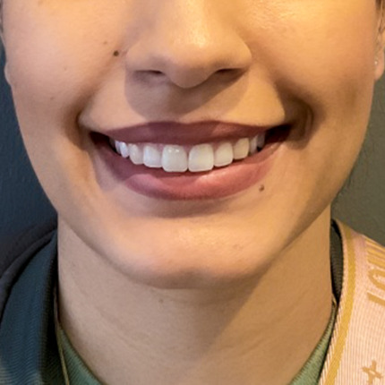 CeriX-web-foer-efter-lipflip-gummysmile1