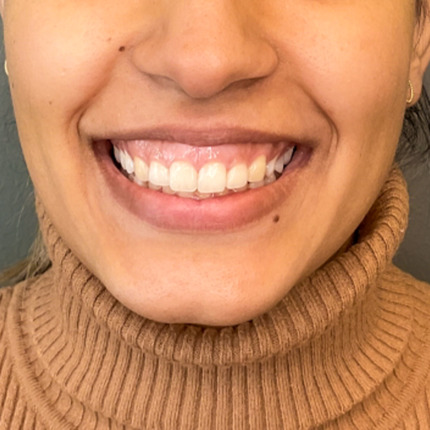 CeriX-web-foer-efter-lipflip-gummysmile2