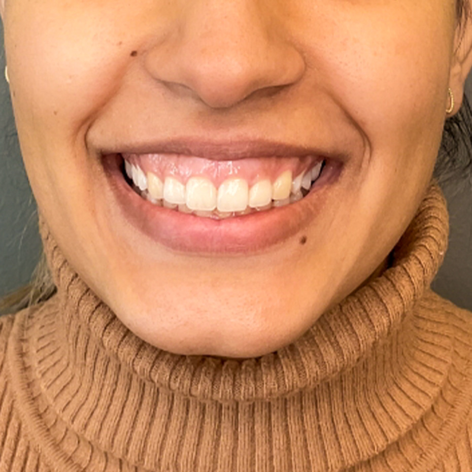 CeriX-web-foer-efter-lipflip-gummysmile2