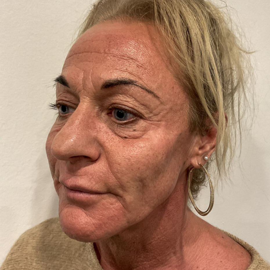 kombinationsbehandling-efter1