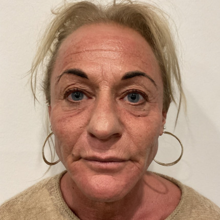 kombinationsbehandling-efter2