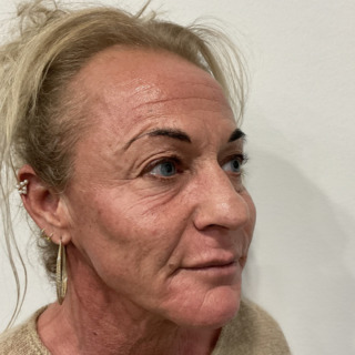 kombinationsbehandling-efter3