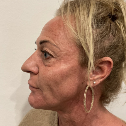 kombinationsbehandling-efter4