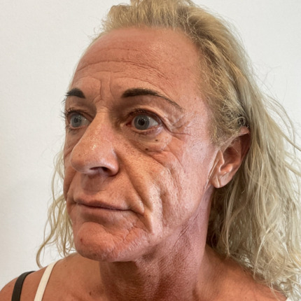 kombinationsbehandling-før1