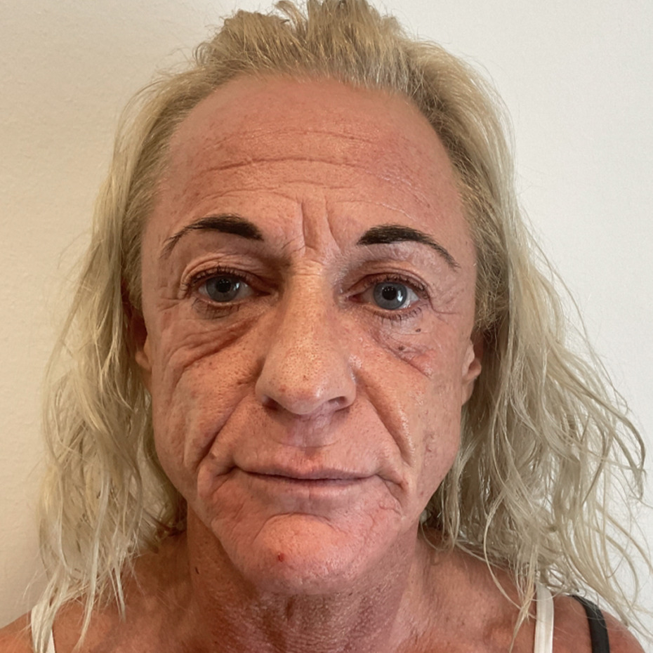 kombinationsbehandling-før2