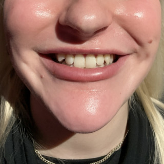 Website-lipflip-før1