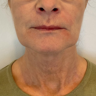 CeriX-efter-marionet + NFL med filler