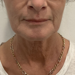 CeriX-foer-marionet + NFL med filler