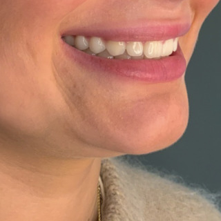 cerix-lipflip-efter1