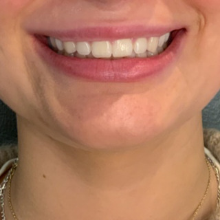cerix-lipflip-efter2