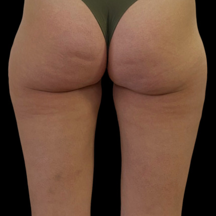 CeriX-sonekos-cell-efter