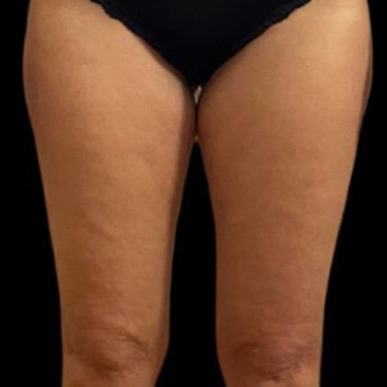 CeriX-sonekos-cell-efter2