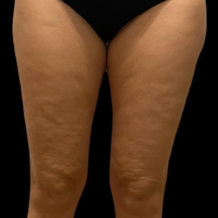 CeriX-sonekos-cell-før2