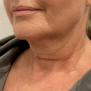 CeriX-ultherapy-hals-og-kæbelinje1
