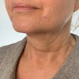 CeriX-ultherapy-hals-og-kæbelinje2-1
