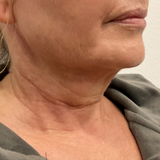 CeriX-ultherapy-hals-og-kæbelinje2