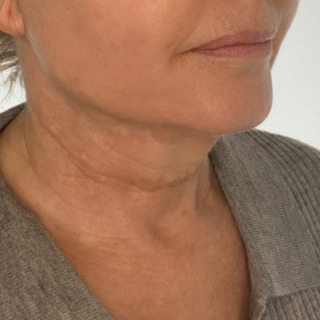 CeriX-ultherapy-hals-og-kæbelinje4
