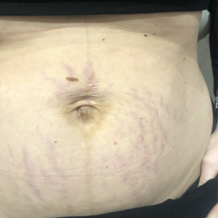 strækmærker-mave-cerix1