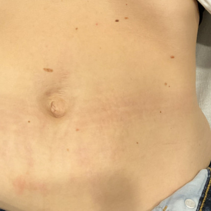 strækmærker-mave-cerix2