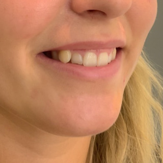 Lipflip-efter