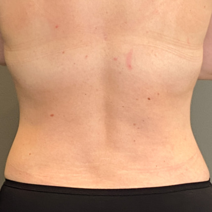 fedtsugning-stor-maveplastik-efter3