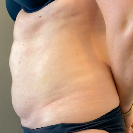 fedtsugning-stor-maveplastik-foer2