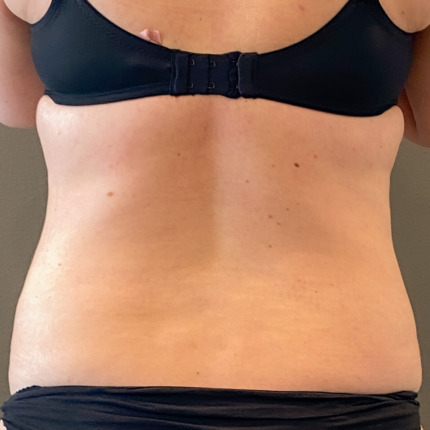 fedtsugning-stor-maveplastik-foer3