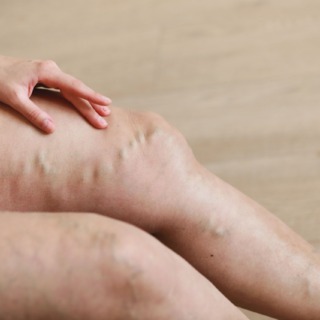 Painful varicose and spider veins on active womans legs, self-helping herself in overcoming the pain. Vascular disease, varicose veins problems, active life concept.
