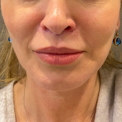 Facelift-liplift-øvre-nedre-øjenl-fedt-til-ansigt-EFTER1