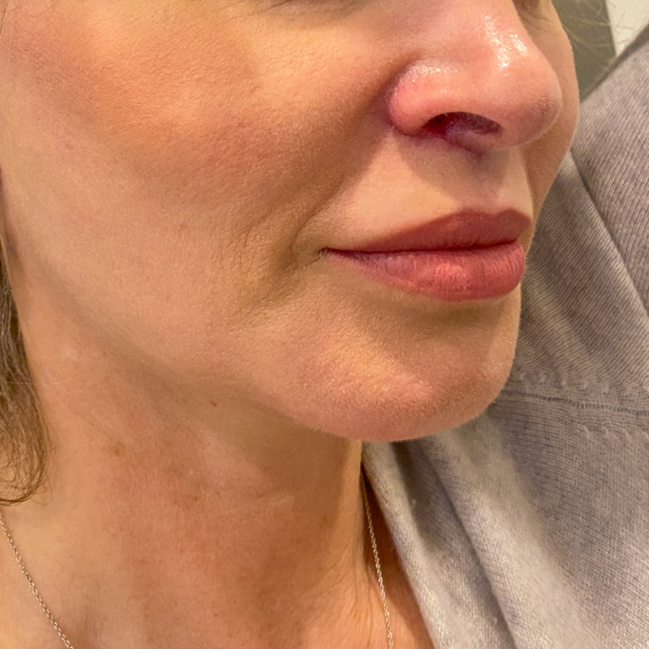 Facelift-liplift-øvre-nedre-øjenl-fedt-til-ansigt-EFTER2