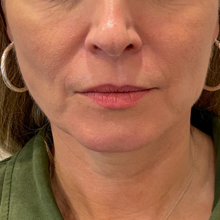 Facelift-liplift-øvre-nedre-øjenl-fedt-til-ansigt-FØR1