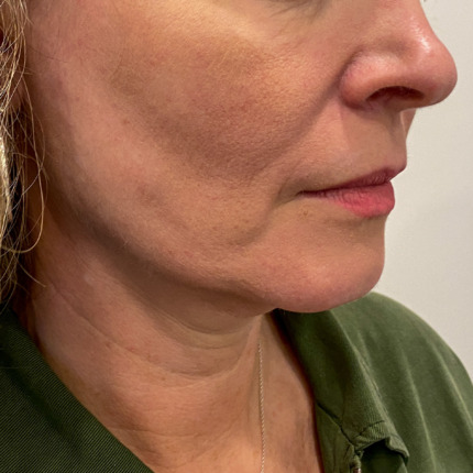 Facelift-liplift-øvre-nedre-øjenl-fedt-til-ansigt-FØR2