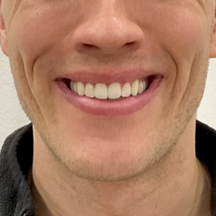 CeriX-Tandkødssmil-efter