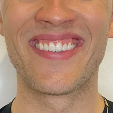 CeriX-Tandkødssmil-før